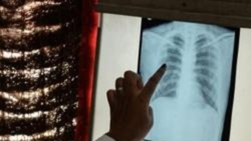 India's Medical Colleges Leading the Fight Against TB