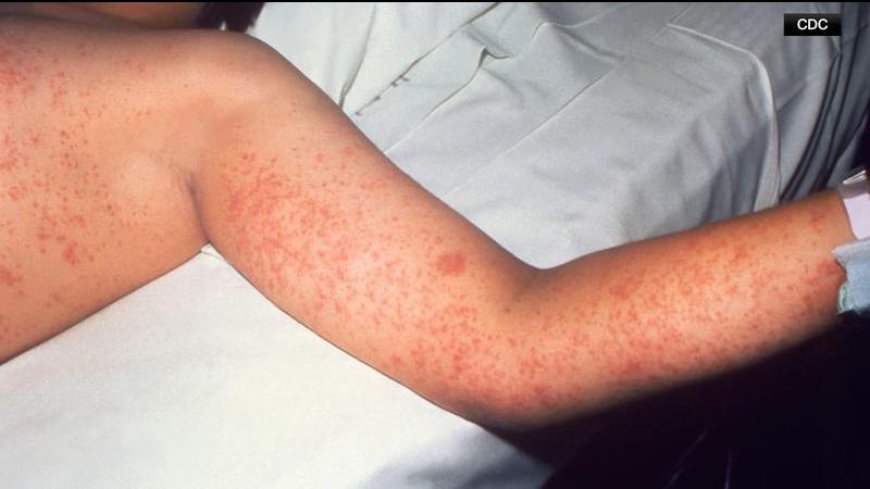 Measles Case Confirmed in Kamloops: Locations of Possible Exposure Listed by IH
