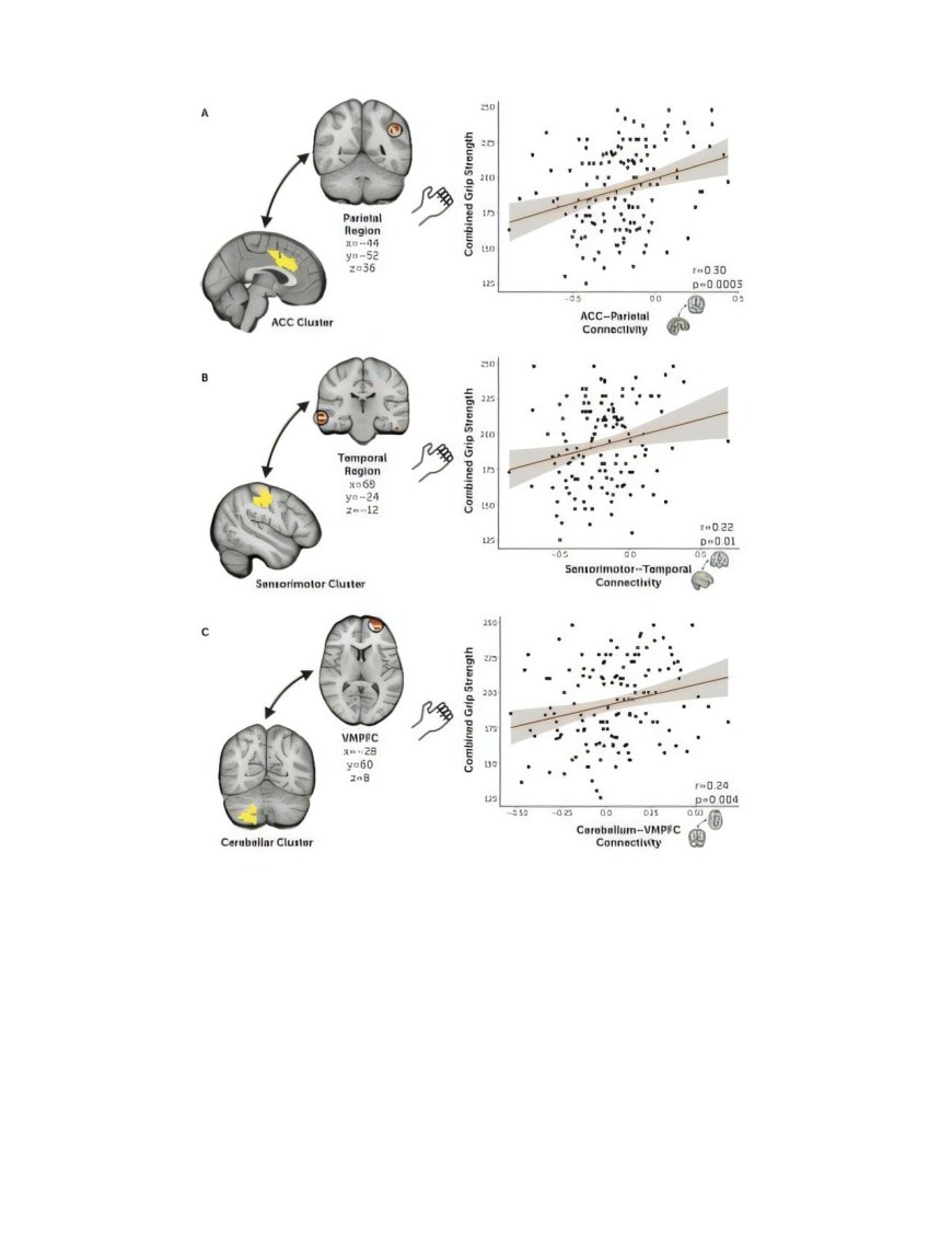 Study Links Grip Strength to Brain Health in Early Psychosis