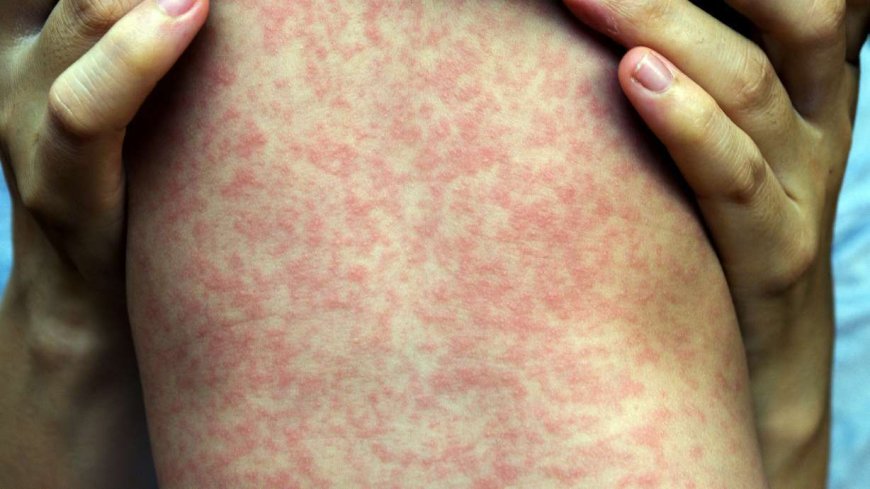 Two more Utah residents diagnosed with measles, total cases now at 5