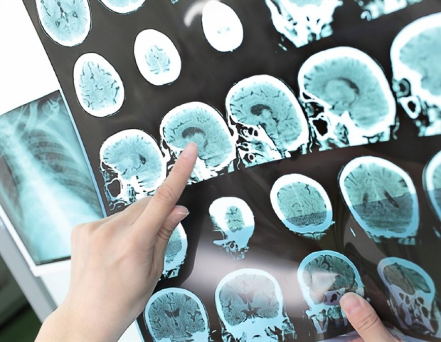 Study Shows Starting Anticoagulants Early Can Prevent Repeat Strokes in Atrial Fibrillation Patients