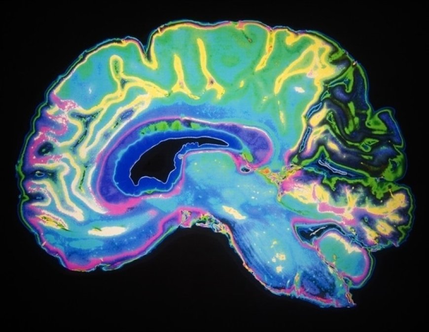 Study Links Brain Injury to Criminal Behavior