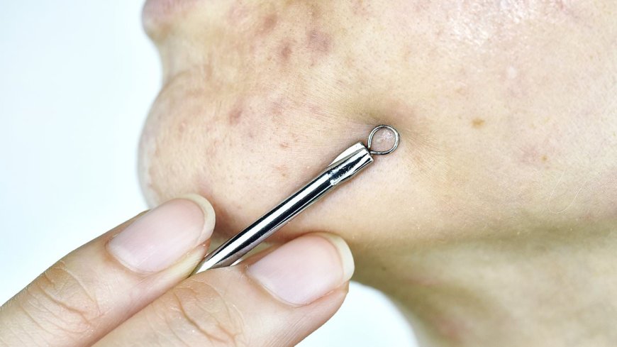Dermatologist's Warning: Avoid Popping Spots to Prevent Scarring