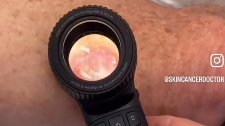 Skin Cancer Doctor Shares Shocking Video of Worst Melanoma: Not All Look Like Moles