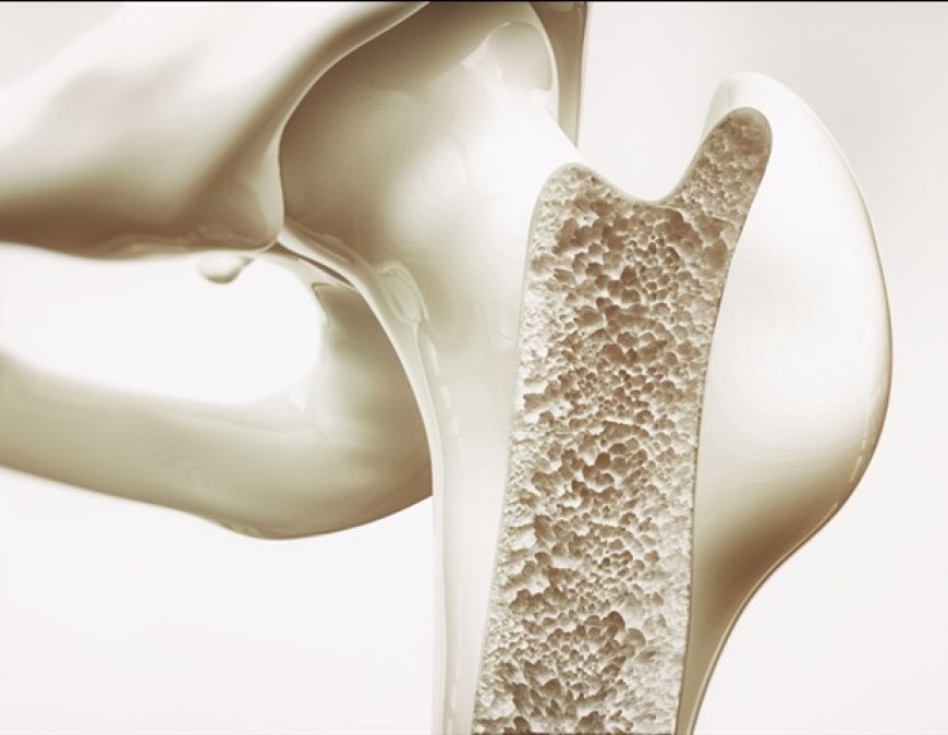 Mount Sinai Improves Treatment for Osteoporosis Fractures