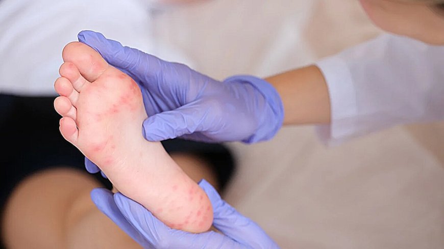 US Measles Cases Surge to Highest Level in 25 Years