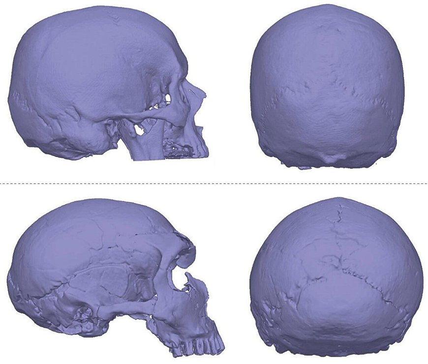 Neanderthal DNA Linked to Modern Brain Malformations: Study