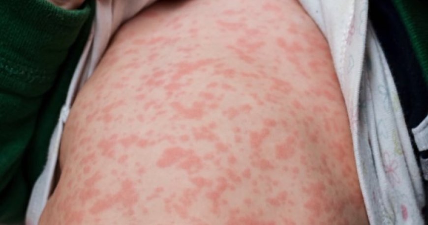 Measles Cases in British Columbia Reach 102, Majority in Northern Health Region