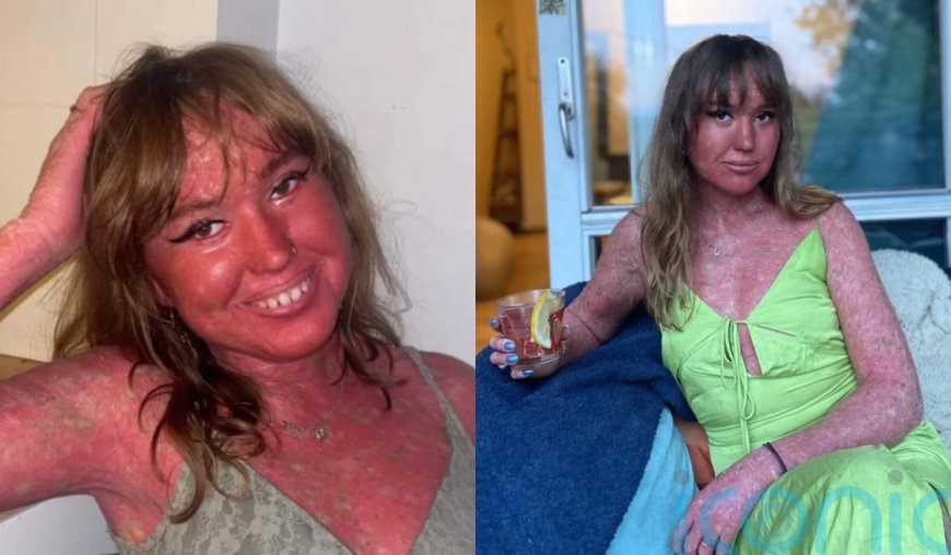 Woman Embraces Rare Skin Condition Despite Bullying, Finds Beauty in Uniqueness