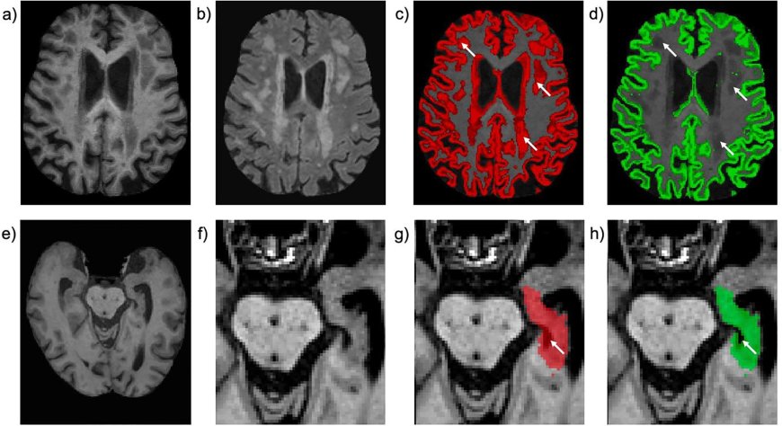 UK Biobank Completes Largest Human Imaging Project: 100,000 Volunteers Provide Detailed Body Scans