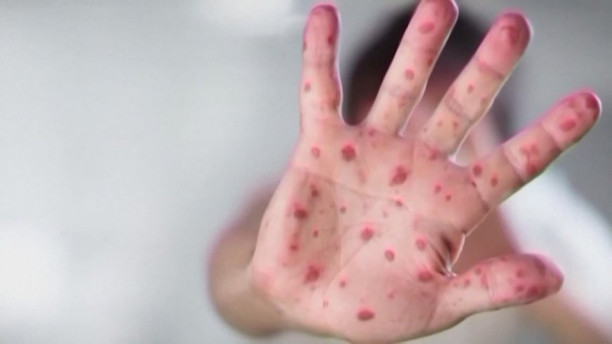 Understanding Measles and Vaccines: Expert Insights from Cleveland Clinic Doctor