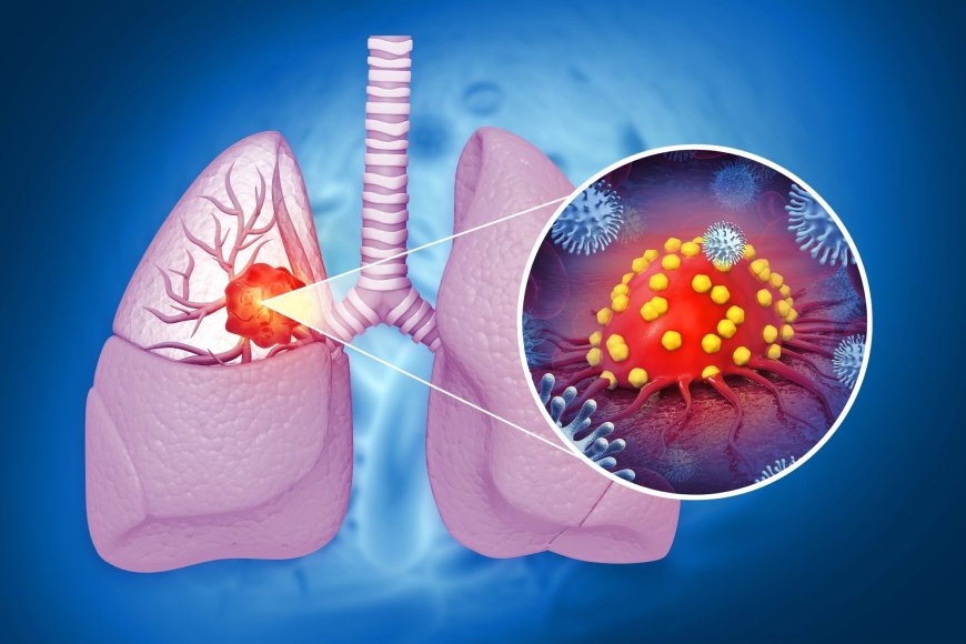 Study Finds Link Between Allergies and Reduced Lung Cancer Risk