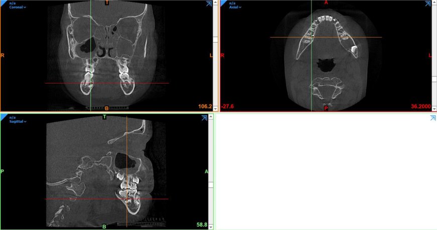 Enhancing Pediatric Dentistry Education with 3D-Printed Models