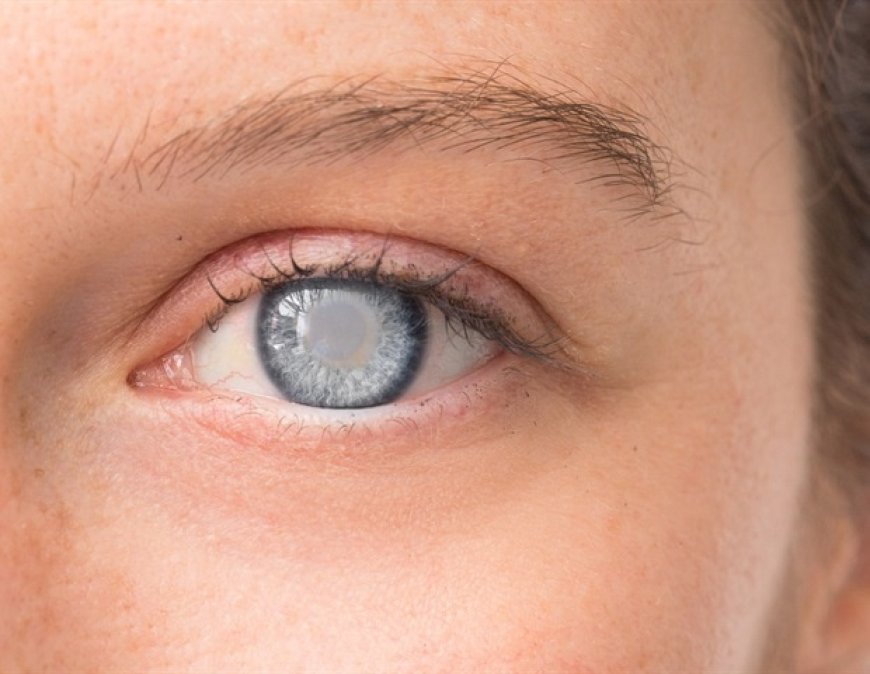 Study Reveals NR2F1 Role in Fibrotic Cataract Development